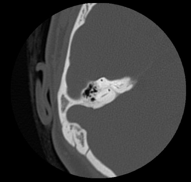 File:Cholesteatoma (Radiopaedia 20296-20217 bone window 34).jpg