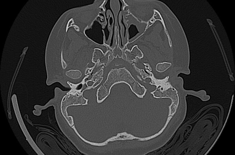 File:Cholesteatoma (Radiopaedia 73023-83750 Axial bone window 16).jpg