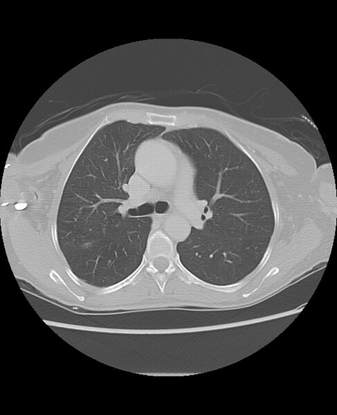 File:Chondrosarcoma (Radiopaedia 79427-92532 Axial lung window 22).jpg