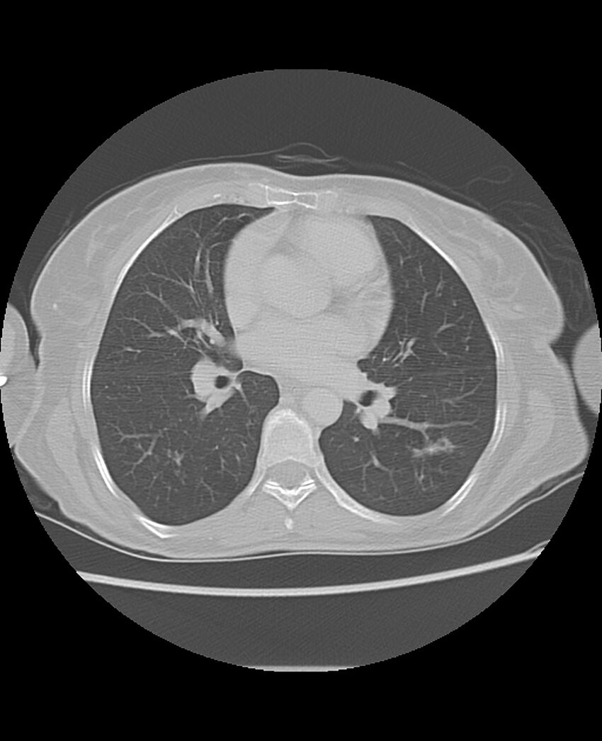 Chondrosarcoma (Radiopaedia 79427-92532 Axial lung window 30).jpg
