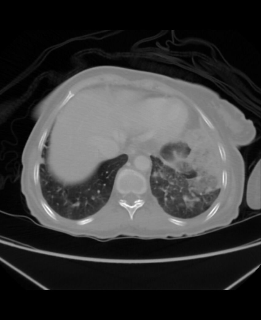 Chondrosarcoma (Radiopaedia 79427-92535 Axial lung window 43).jpg