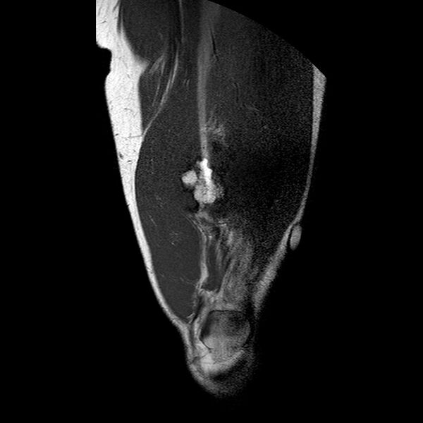 File:Chondrosarcoma arising from exostosis (Radiopaedia 59996-67686 Coronal T1 TSE LFOV 4).jpg