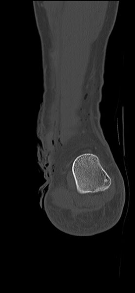 File:Chopart fracture (Radiopaedia 35347-36851 Coronal bone window 15).jpg