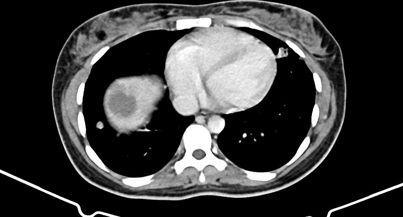 File:Choriocarcinoma liver metastases (Radiopaedia 74768-85766 A 16).jpg
