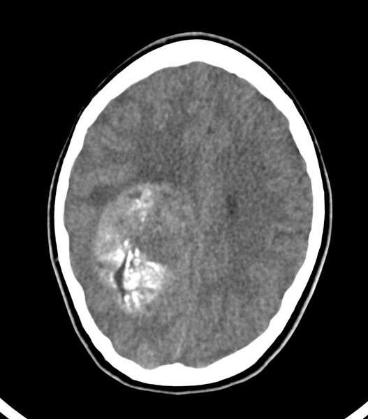 File:Choroid plexus carcinoma (Radiopaedia 91013-108552 Axial non-contrast 41).jpg