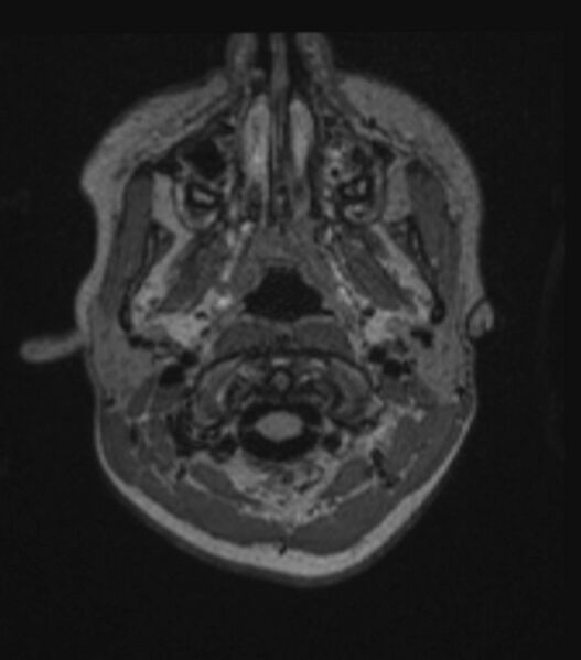 File:Choroid plexus carcinoma (Radiopaedia 91013-108553 Axial FLAIR C+ 64).jpg