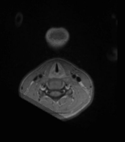 File:Choroid plexus carcinoma (Radiopaedia 91013-108553 Axial T1 C+ 2).jpg