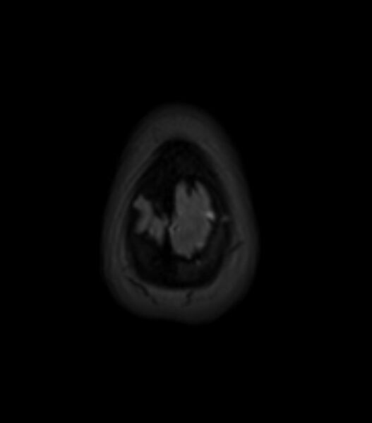 File:Choroid plexus carcinoma (Radiopaedia 91013-108553 Axial T2 fat sat 155).jpg