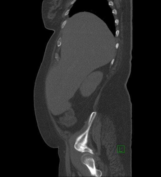 File:Chromophobe renal cell carcinoma (Radiopaedia 84239-99519 Sagittal bone window 87).jpg