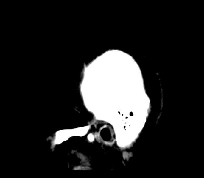 File:Chronic bilateral occipital lobe infarcts (Radiopaedia 31276-31996 C 37).jpg