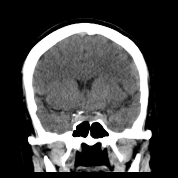 File:Chronic bilateral occipital lobe infarcts (Radiopaedia 31276-31996 Coronal non-contrast 20).jpg