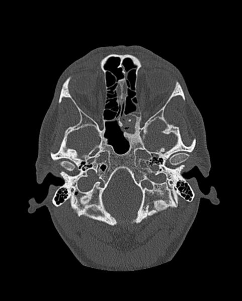 File:Chronic maxillary sinusitis caused by a foreign body (Radiopaedia 58521-65676 Axial bone window 212).jpg