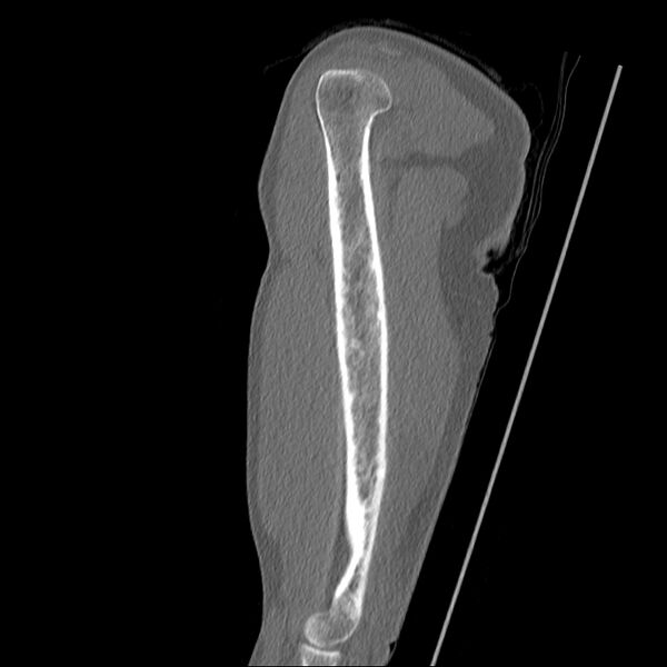 File:Chronic osteomyelitis (Radiopaedia 67597-76998 Sagittal bone window 16).jpg
