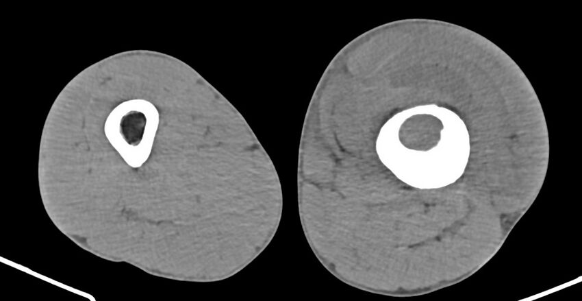 Chronic osteomyelitis (with sequestrum) (Radiopaedia 74813-85822 D 111).jpg