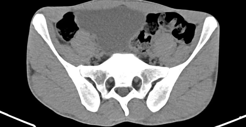 Chronic osteomyelitis (with sequestrum) (Radiopaedia 74813-85822 D 6).jpg