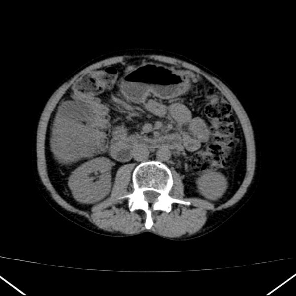 File:Chronic pancreatitis (Radiopaedia 23132-23172 Axial non-contrast 39).jpg