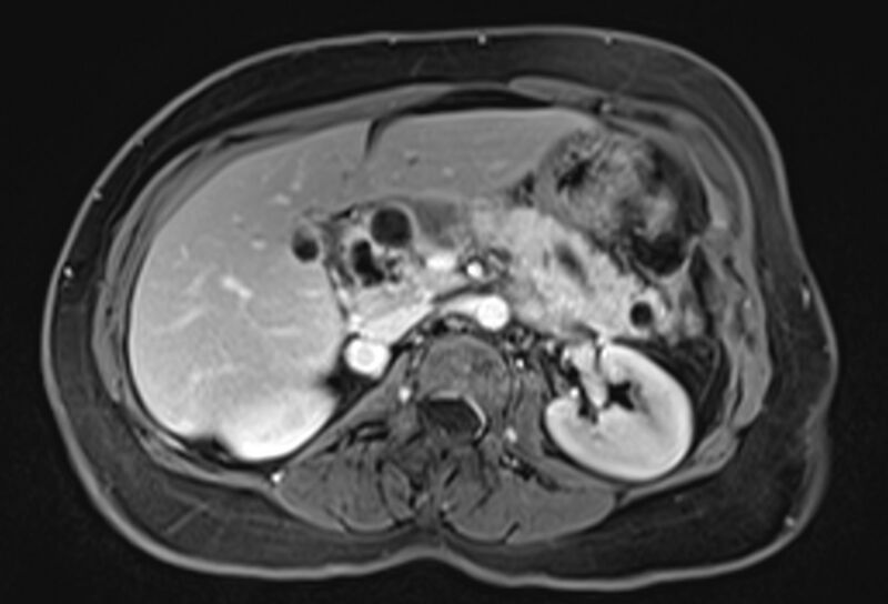 File:Chronic pancreatitis - pancreatic duct calculi (Radiopaedia 71818-82250 Axial T1 C+ fat sat 28).jpg