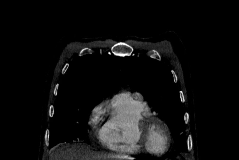 File:Chronic pulmonary embolism with bubbly consolidation (Radiopaedia 91248-108850 B 22).jpg