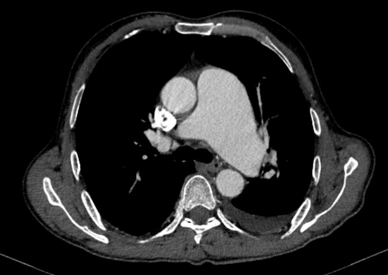 File:Chronic pulmonary embolism with bubbly consolidation (Radiopaedia 91248-108850 C+ arterial phase 60).jpg