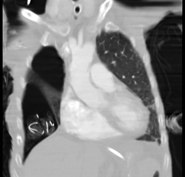 File:Clagett thoracotomy with bronchopleural fistula (Radiopaedia 29192-29587 Coronal lung window 22).jpg