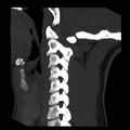 Clay-shoveler fracture (Radiopaedia 22568-22590 Sagittal MIP 14).jpg