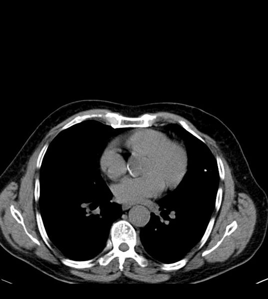File:Clear cell renal cell carcinoma (Radiopaedia 85006-100539 Axial non-contrast 3).jpg