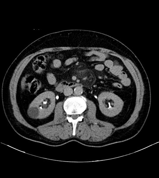 File:Clear cell renal cell carcinoma (Radiopaedia 85006-100539 H 21).jpg