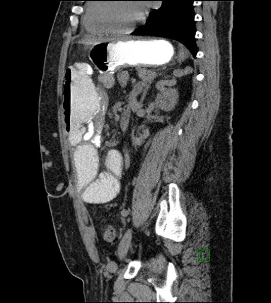 File:Closed-loop small bowel obstruction-internal hernia (Radiopaedia 78439-91096 C 60).jpg
