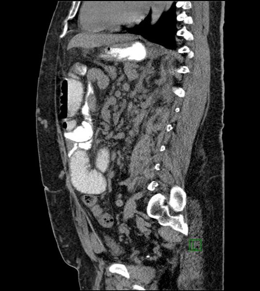 File:Closed-loop small bowel obstruction-internal hernia (Radiopaedia 78439-91096 C 66).jpg