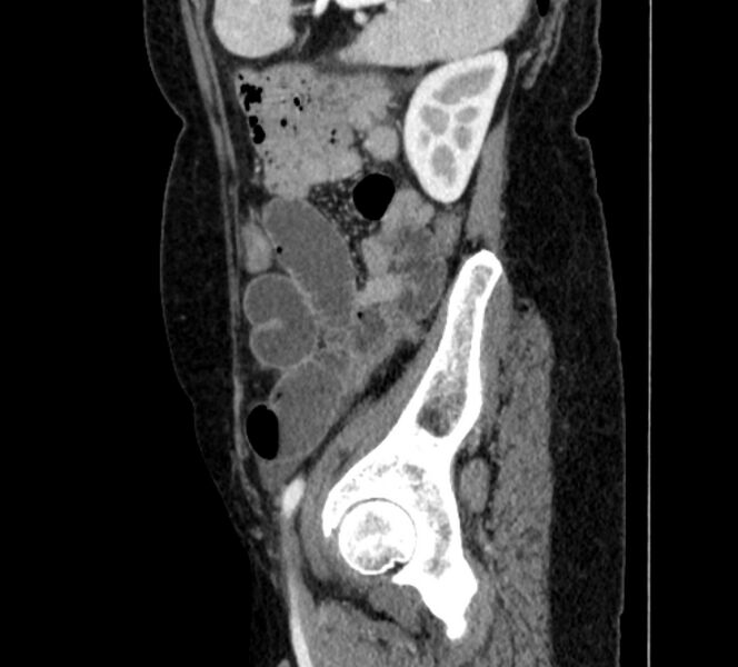 File:Closed loop small bowel obstruction (Radiopaedia 71211-81508 C 131).jpg