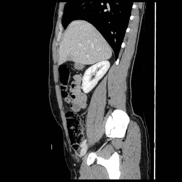 File:Co-existing acute appendicitis and epiploic appendagitis (Radiopaedia 61789-69911 B 29).jpg
