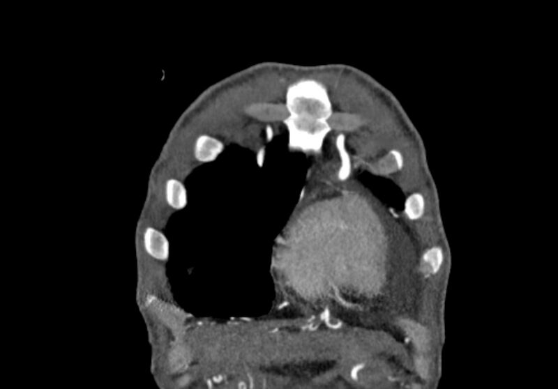 File:Coarctation of aorta with aortic valve stenosis (Radiopaedia 70463-80574 C 6).jpg