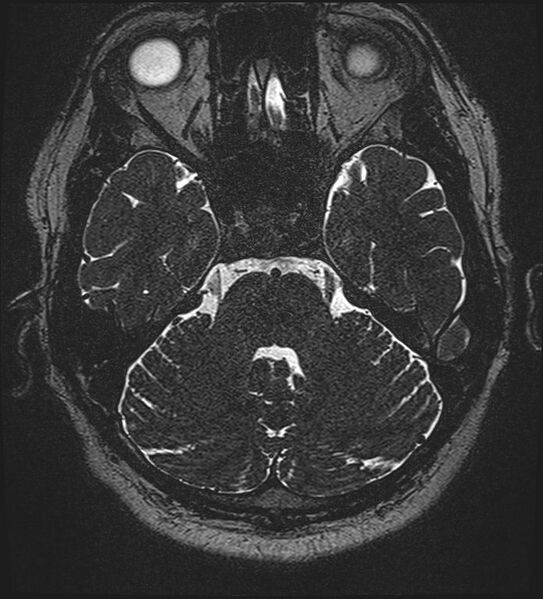 File:Cochlear incomplete partition type III associated with hypothalamic hamartoma (Radiopaedia 88756-105498 Axial T2 100).jpg