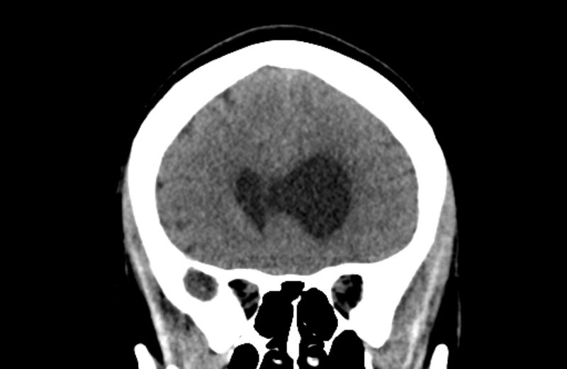 File:Colloid cyst (Radiopaedia 53180-59146 Coronal non-contrast 21).jpg