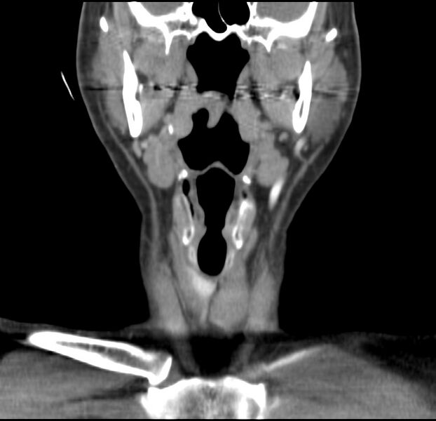 File:Colloid cyst of thyroid (Radiopaedia 22897-22923 Coronal C+ delayed 24).jpg