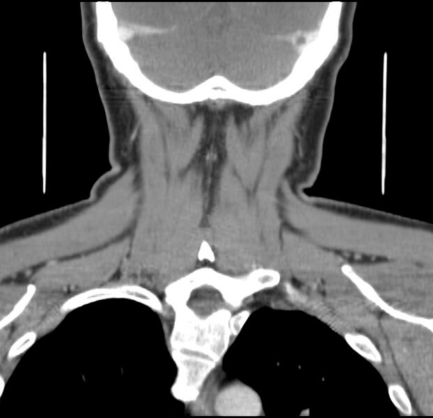 File:Colloid cyst of thyroid (Radiopaedia 22897-22923 Coronal C+ delayed 50).jpg
