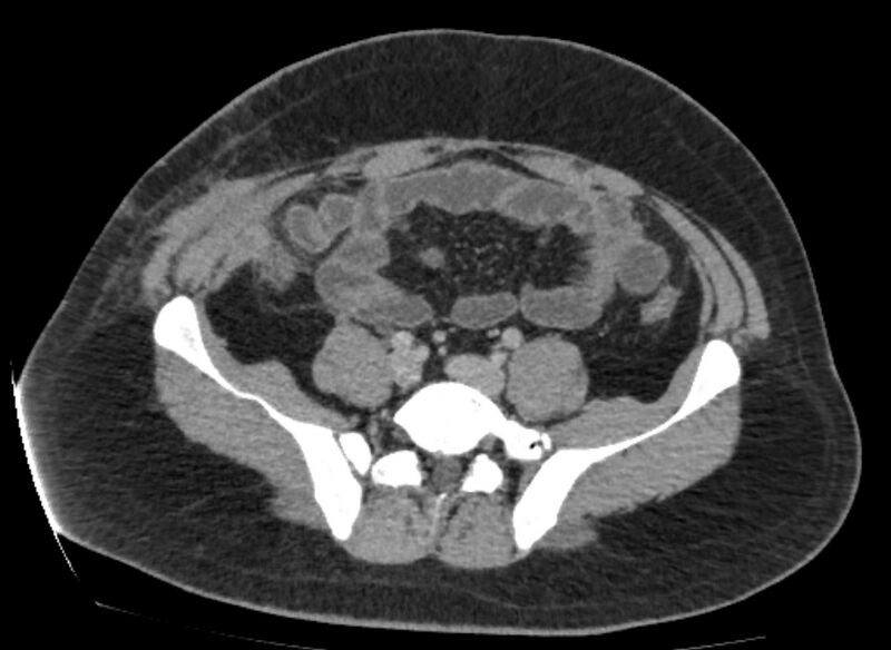 File:Colocutaneous fistula (Radiopaedia 56401-63062 A 65).jpg