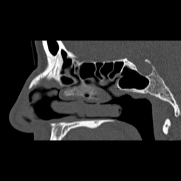 File:Nasal septal perforation (Radiopaedia 25030-25289 Sagittal bone window 23).jpg