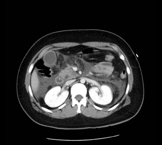 File:Necrotizing pancreatitis (Radiopaedia 23001-23031 A 31).jpg