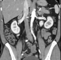 Necrotizing pancreatitis with acute necrotic collection (Radiopaedia 14470-14417 C 23).jpg