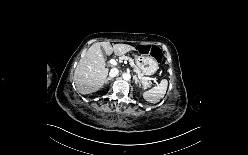 Neo-terminal ileal stricture (Crohn disease) (Radiopaedia 33790-34948 A 121).jpg