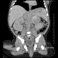 Neonatal neuroblastoma (Radiopaedia 56651-63438 Coronal non-contrast 31).jpg