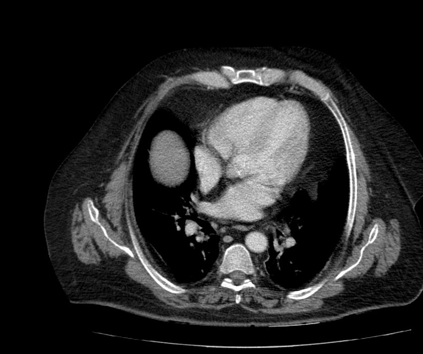 Nephroptosis with inguinal hernia containing perirenal fat (Radiopaedia 56632-63391 C 17).jpg
