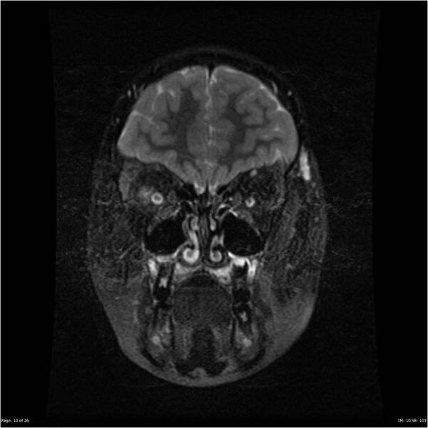 File:Neurofibromatosis type 1 (Radiopaedia 22541-22564 Coronal T2 fat sat 1).jpg