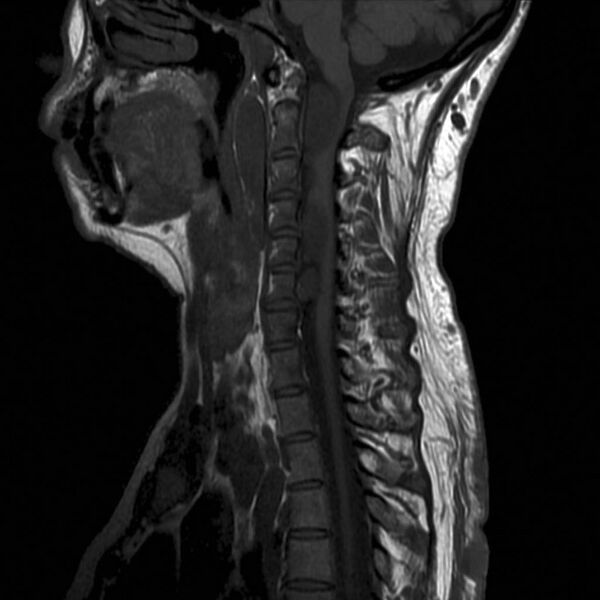 File:Neurofibromatosis type 1 (Radiopaedia 9159-9859 Sagittal T1 1).jpg
