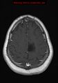 Neuroglial cyst (Radiopaedia 10713-11184 Axial T1 C+ 5).jpg