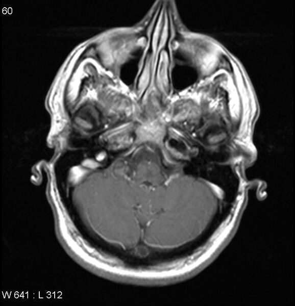 File:Neurosarcoidosis (Radiopaedia 10930-17204 Axial T1 C+ 3).jpg