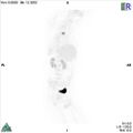 Non-Hodgkin lymphoma involving seminal vesicles with development of interstitial pneumonitis during Rituximab therapy (Radiopaedia 32703-33752 PET cor 3D MIP 9).jpg