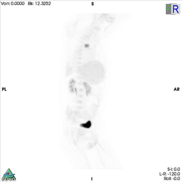 File:Non-Hodgkin lymphoma involving seminal vesicles with development of interstitial pneumonitis during Rituximab therapy (Radiopaedia 32703-33752 PET cor 3D MIP 9).jpg