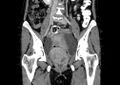 Non-puerperal uterine inversion (Radiopaedia 78343-91094 B 1).jpg